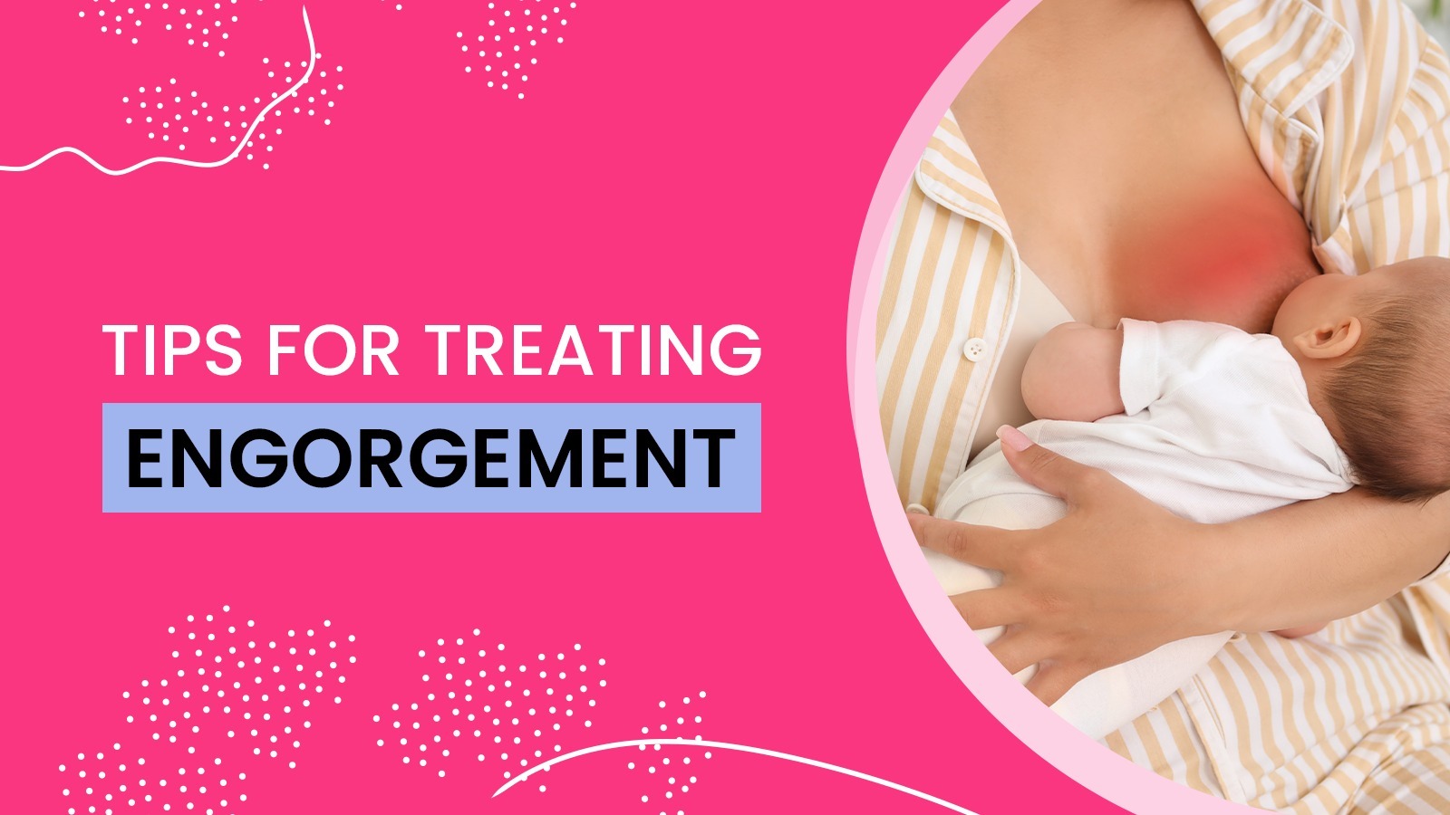 breast engorgement